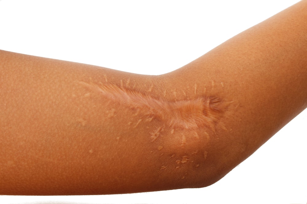 ASTYM Treatment for Post Surgical Scar Tissue