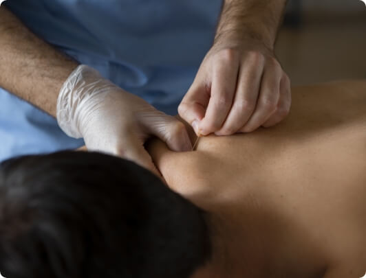 https://osrphysicaltherapy.com/wp-content/uploads/2023/04/Dry-Needling.jpg