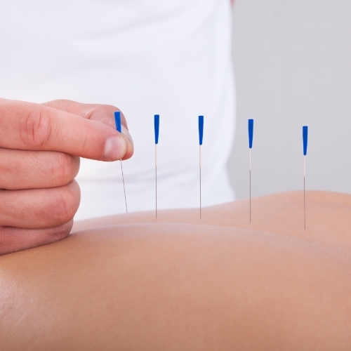Scottsdale Electro Dry Needling by a Physical Therapist & Pricing