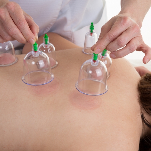 physical-therapy-clinic-cupping-OSR-Physical-Therapy-Phoenix-Scottsdale-Peoria-Anthem-Glendale-AZ